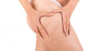 cellulite