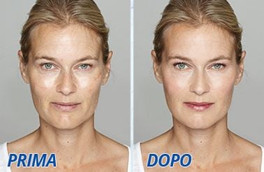 Hydraxil prima e dopo
